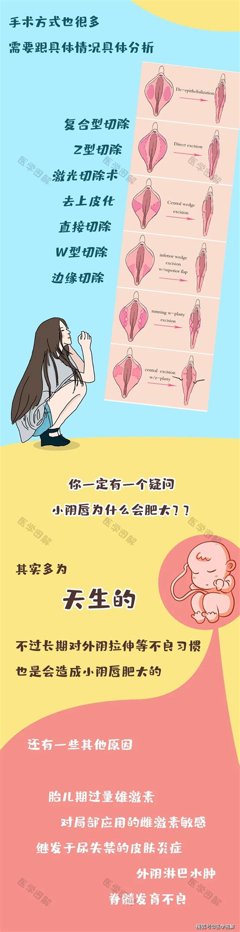 女性户型|原来女性私处还有这么多型？这种形状一定要当心！丨。